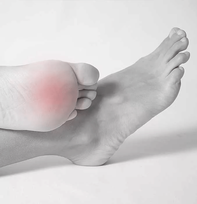 Metatarsalgia symptoms